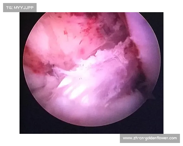 李昌邦康复日记揭秘肩部手术采用德国3D打印韧带技术背后的故事